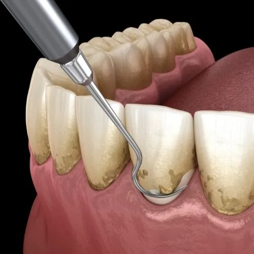 Periodoncia